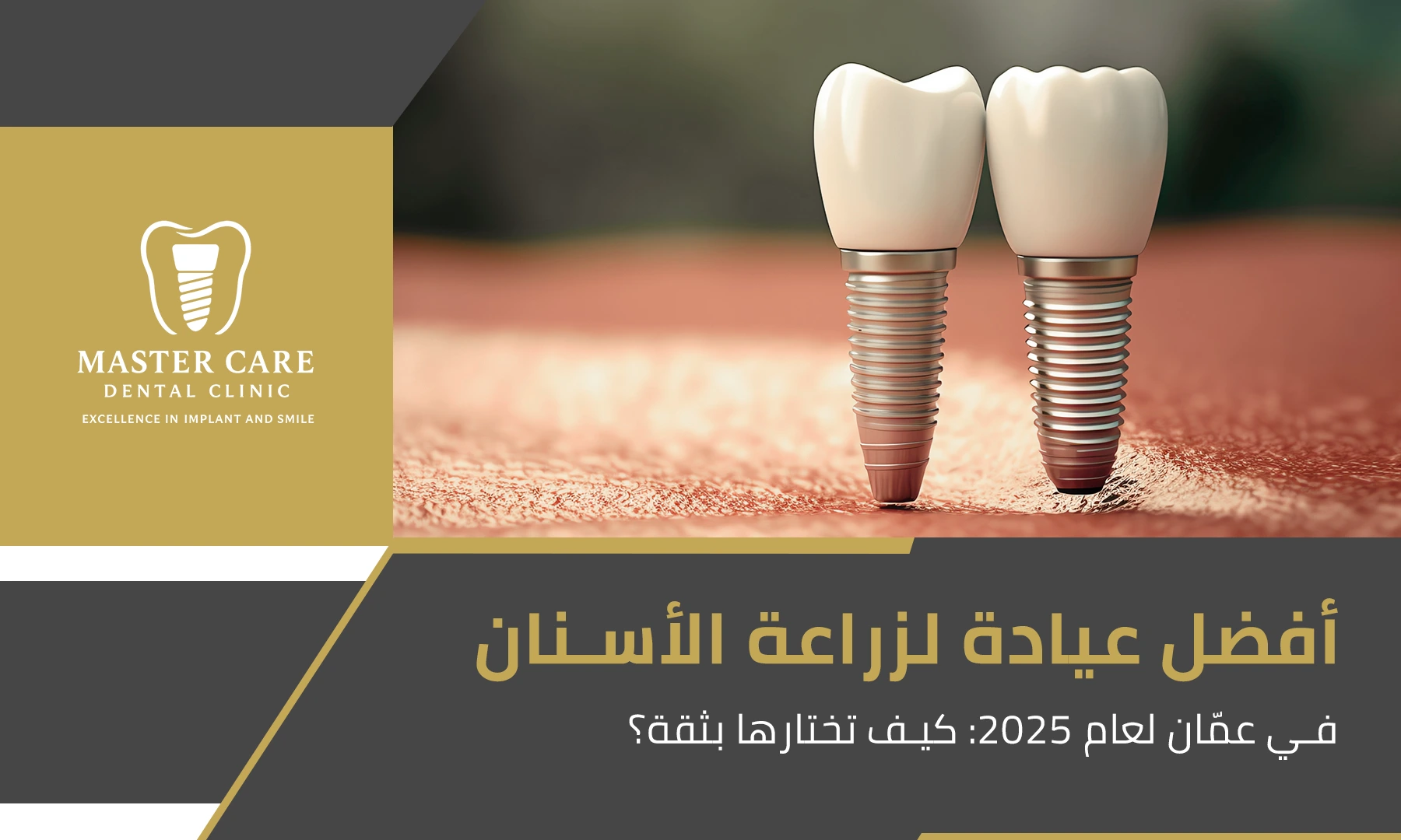 خدمات متقدمة في زراعة الأسنان في عمّان مع اختيار العيادة الأنسب لنتائج مضمونة.