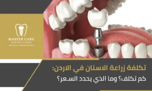 تكلفة زراعة الاسنان في الاردن
