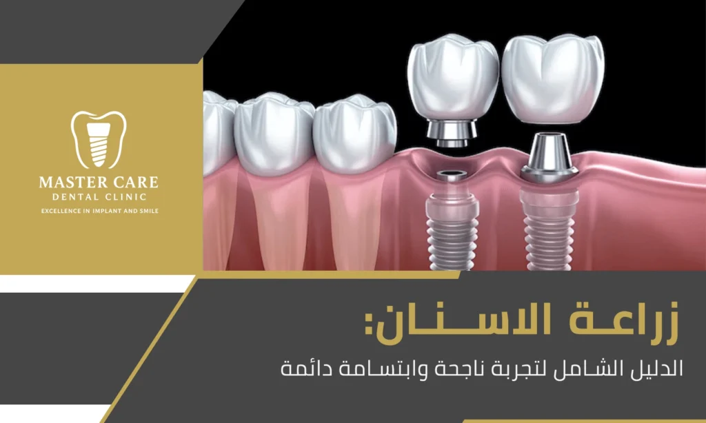 زراعة الاسنان: الدليل الشامل لتجربة ناجحة وابتسامة دائمة